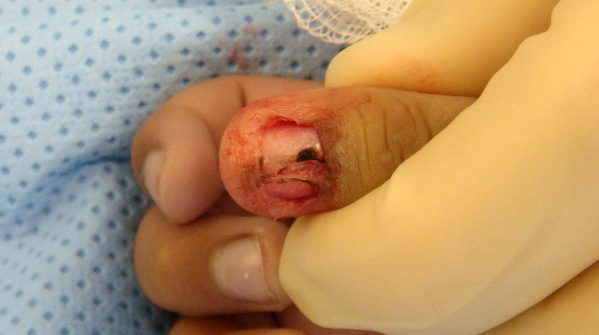 Blue Nevus Thumb Nail - Partial excision of melanotic area
