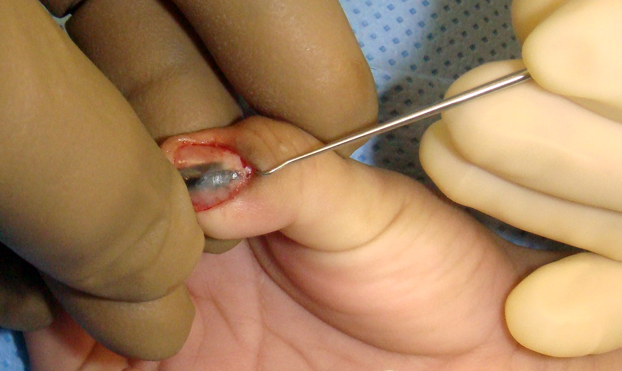 Blue Nevus Thumb Nail - Nailplate being removed