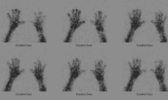 Normal, Blood Flow Phase of a 3 phase bone scan with symmetric blood flow to the bilateral hands