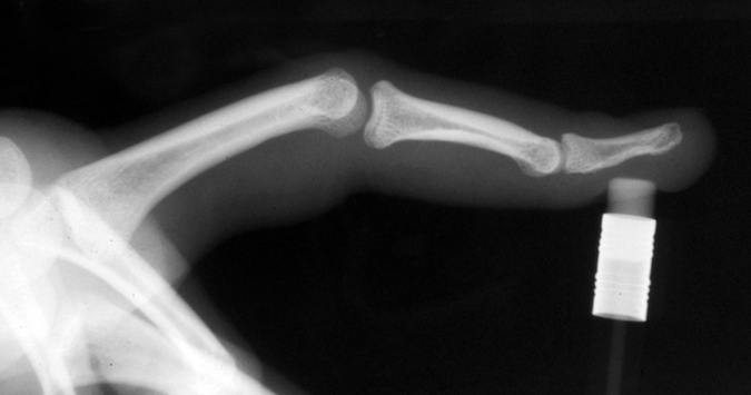 Lateral X-ray of a finger with a boutonniere deformity