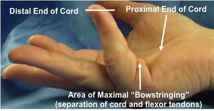 Central Cord - Injection site located in part of the cord which is most "bowstrung" (displaced away from the flexor tendons).