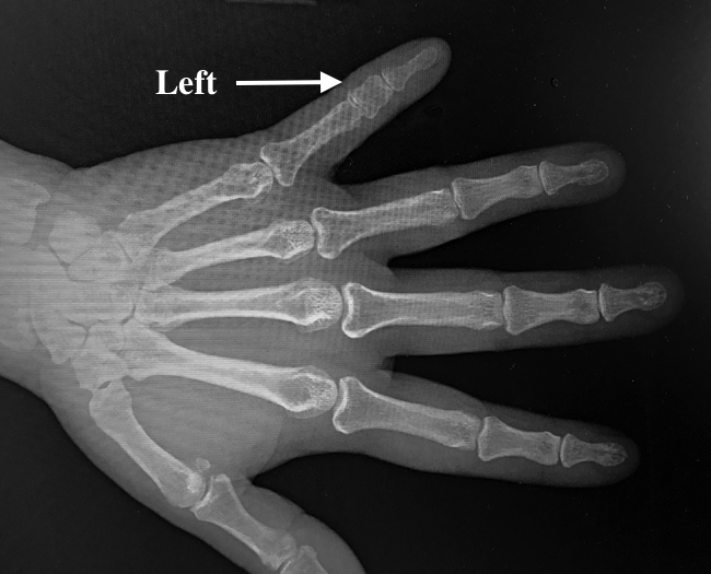 Left Fifth Finger Brachydactyly