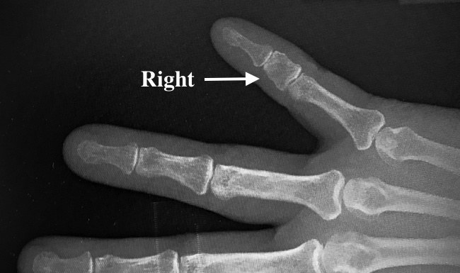 Right Fifth Finger Brachydactyly