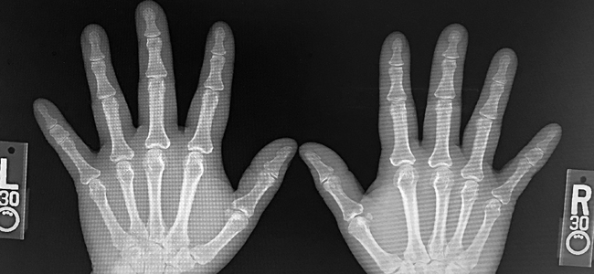 Bilateral Fifth Finger Brachydactyly