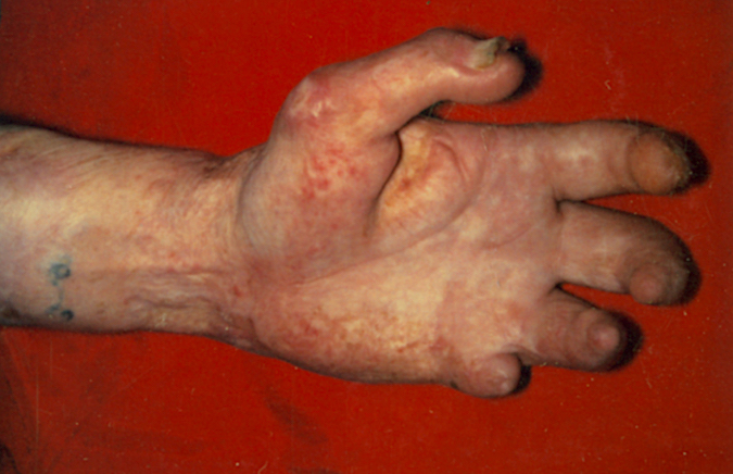 Right hand amputations, contractures, and scarring after severe burn