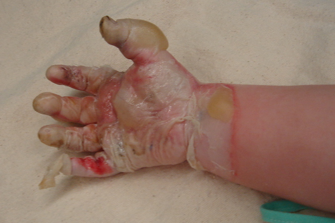 Left hand second degree burn after child fell into a fire pit