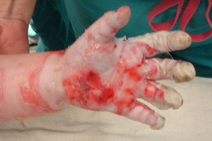 Right hand second degree burn after child fell into a fire pit