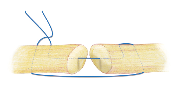 Simple double right angle core suture for thick extensor tendons. A 3-O or 4-O  braided synthetic permanent suture is one acceptable suture  choice for the the core suture.