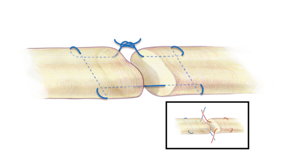 A modified Kessler or Tajima style (insert)  core suture can also be used for the extensors where they are thicker over the dorsal of the hand or wrist.  A 3-O or 4-O  braided synthetic permanent suture is one acceptable suture  choice for the the core suture.