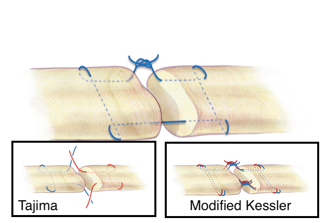 A Kessler core suture (Tajima & Modified Kessler in inserts) for flexor tendon repair. A 3-O or 4-O braided synthetic permanent suture is one acceptable suture choice for the the core suture.
