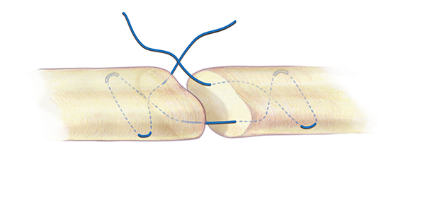 A Modified Bunnell core suture for flexor tendon repair. A 3-O or 4-O braided synthetic permanent suture is one acceptable suture choice for the the core suture. 