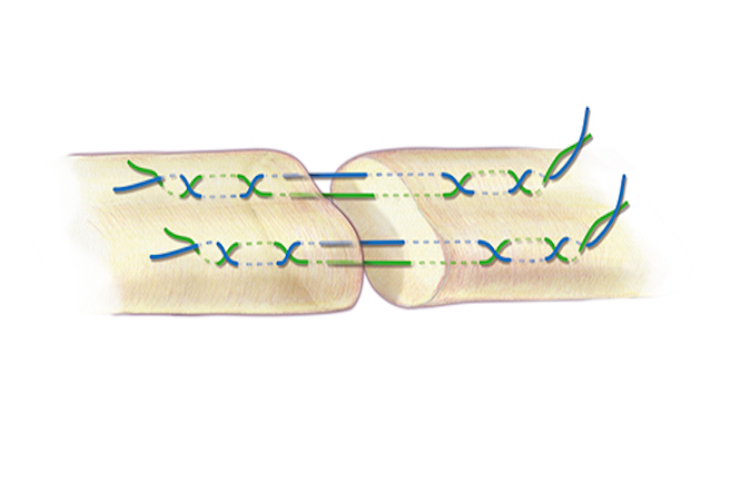 A Savage core suture for flexor tendon repair. A 3-O or 4-O braided synthetic permanent suture is one acceptable suture choice for the the core suture.