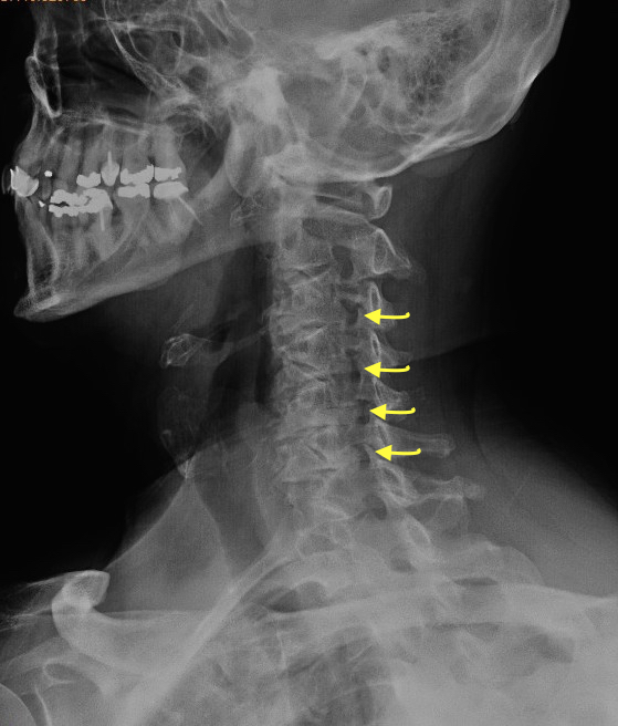 Cervical Osteoarthritis and disc space narrowing on oblique view. Note foramen impingement at arrows.  In this AP view the head is rotated 45 degrees to RIGHT so the LEFT cervical foramen are demonstrated.