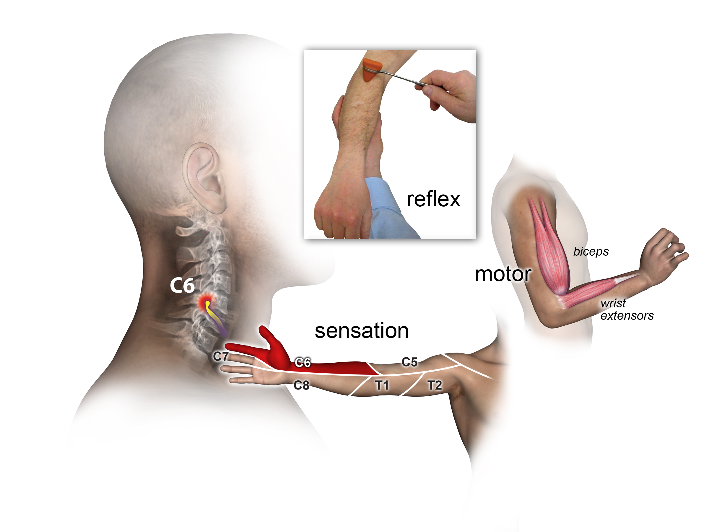 Motor, sensory and triceps reflex exam for C6 Root