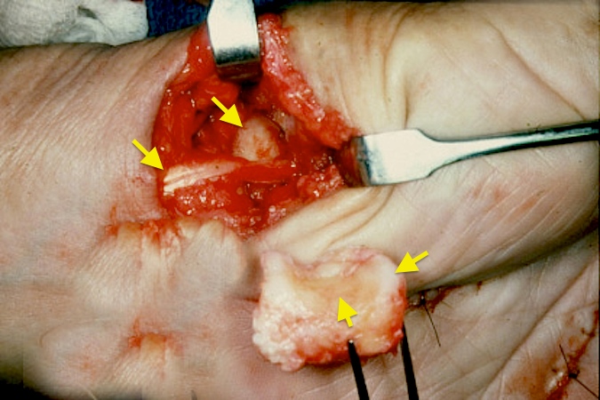 CMC OA Fascial Arthroplasty Trapezium removed