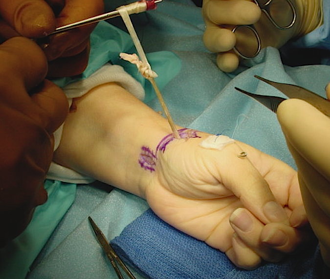 CMC OA Fascial Arthroplasty Suspensionplasty 3