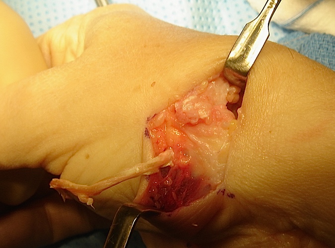 CMC OA Fascial Arthroplasty Suspensionplasty 2