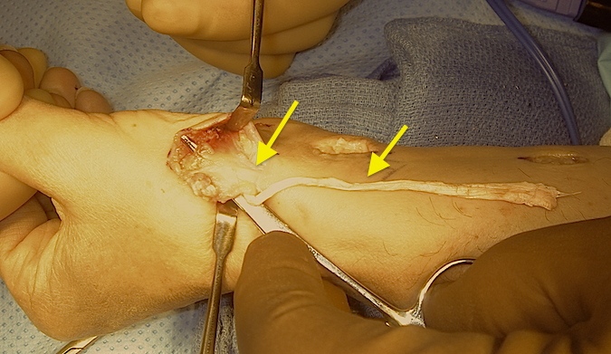 CMC OA Fascial Arthroplasty Suspensionplasty 1