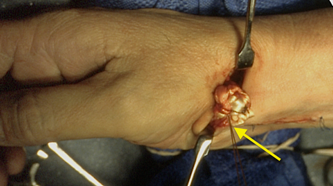 CMC OA Fascial Arthroplasty Suspensionplasty 5