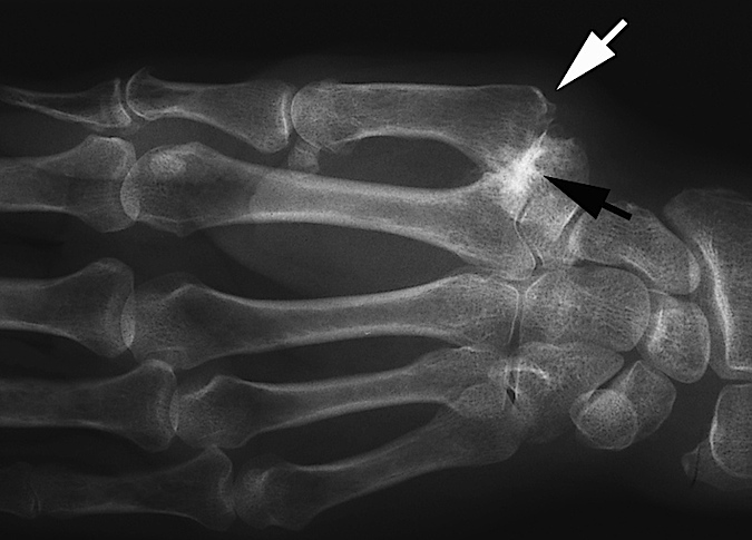 Another thumb CMC (Basal Joint) OA Stage II narrow with debris and osteophytes less than 2 mm; minimal joint narrowing with only a few small erosions only; joint subluxed about one-third of joint width