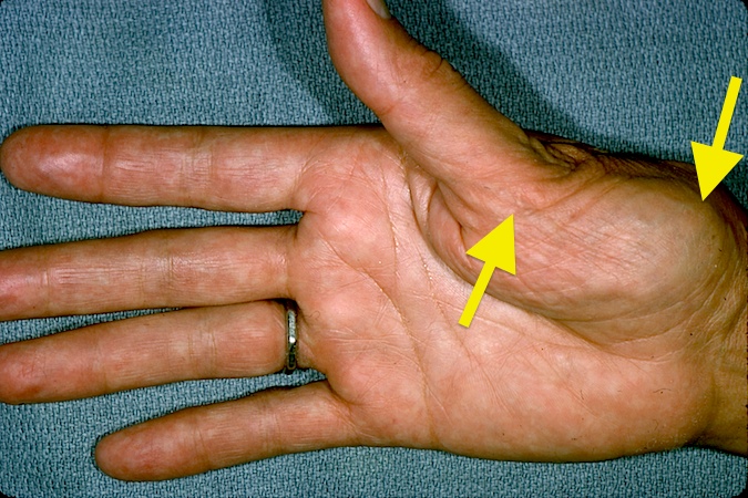Thumb CMC (Basal Joint) OA with CMC Subluxation and MP Hyperextension