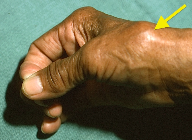 Thumb CMC (Basal Joint) OA with CMC Subluxation