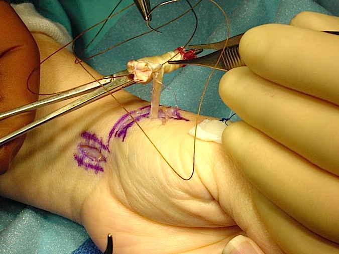 CMC OA Fascial Arthroplasty Suspensionplasty 4