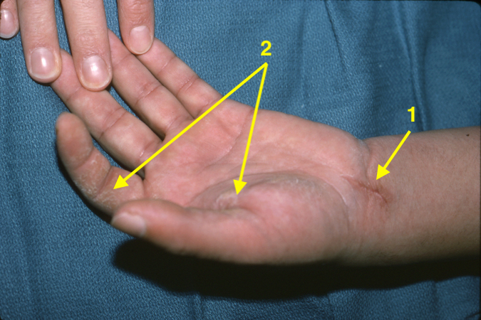 Laceration Median Nerve (1) with anhydrotic skin (2).