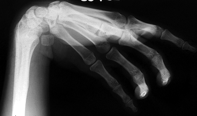 Cerebral Palsy - Spastic Flexor Pronator Deformity X-Ray with persistent contracture.  During growth some skeletal deformities can occur.