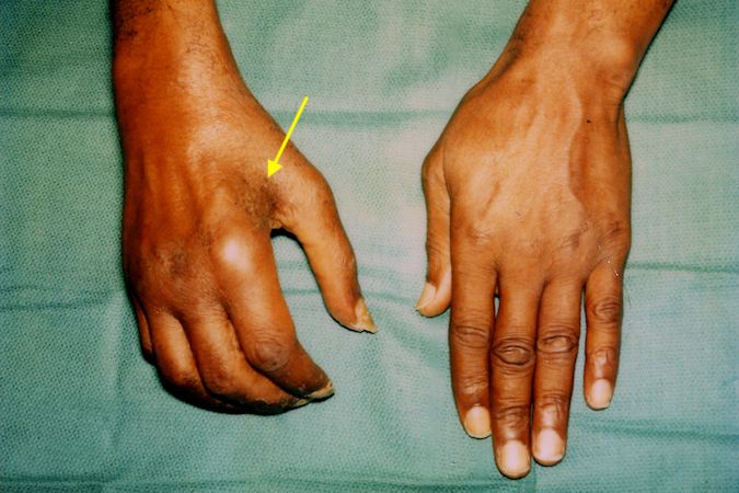 Complex Regional Pain Syndrome Type II in a 46 y.o. male after a bicycle accident  and a closed injury to the ulnar  nerve at the elbow.  Note the intrinsic atrophy (arrow), swollen and stiff hand.