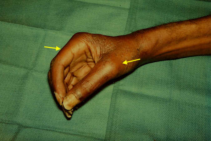 Note the marked lack of active finger flexion and redness (arrows).