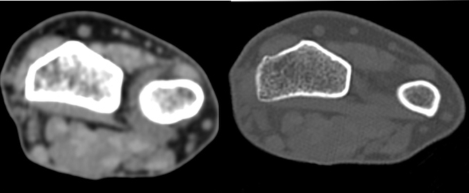 Soft tissue window (left) axial images and bone window (right) axial images