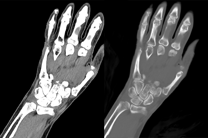  Soft tissue window (left) coronal images and  bone window (right) axial Images