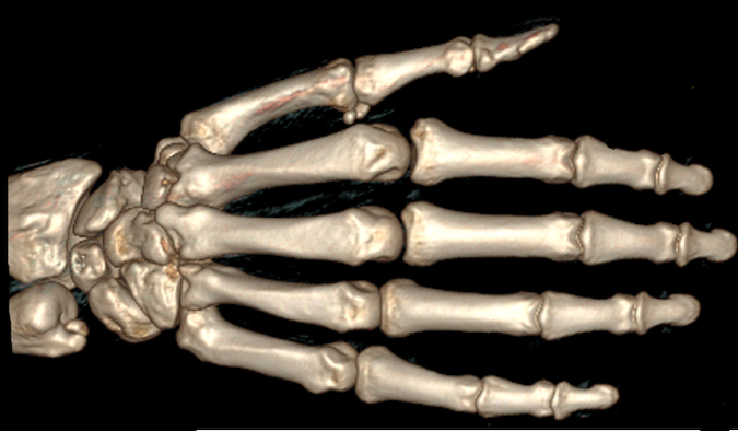 3D reformatted coronal image of the hand