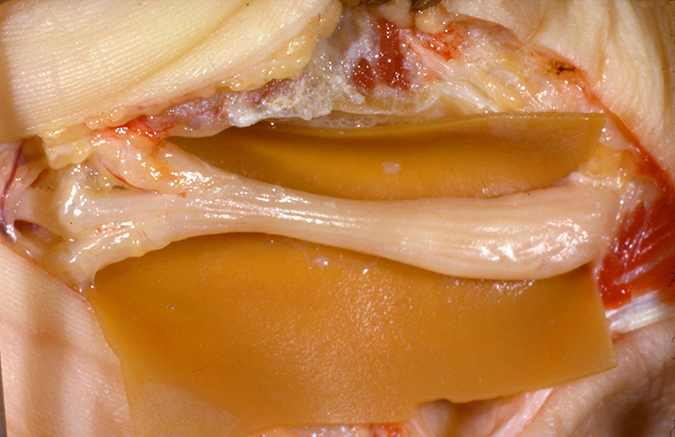 Compressed median nerve with pseudoneuroma proximally (right) and median nerve branches distally.