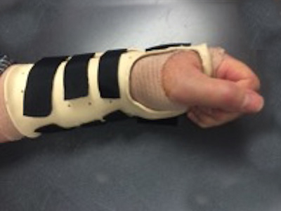 Nighttime splinting is an important part of non-operative carpal tunnel syndrome treatment.