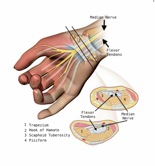 Carpal tunnel anatomy: Carpal bones form the dorsal roof and the sides of the tunnel while the transverse palmar ligament forms the tunnel floor volarly. The tunnel contains nine flexor tendons and the median nerve.