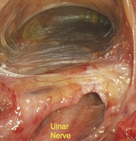 Arthroscopic view of ulnar nerve and fascia