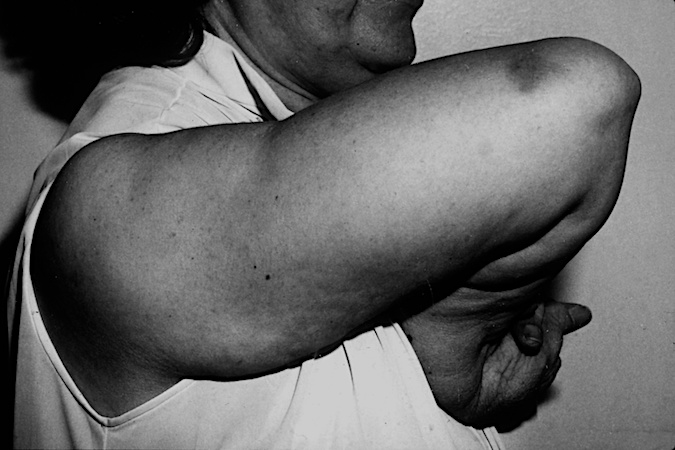 Severe neglected right upper extremity deformity after a CVA.  Note adducted shoulder, flexed elbow, and marked flexor pronator deformity of the forearm and hand.