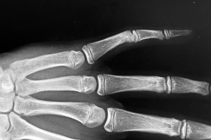 AP X-ray Camptodactyly left fifth finger.