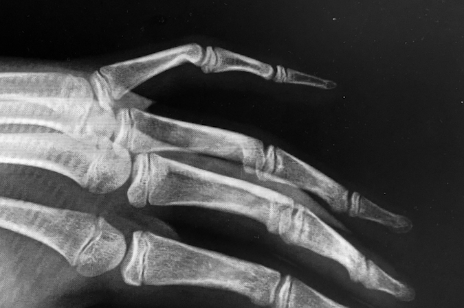 Lateral X-ray Camptodactyly left fifth finger.