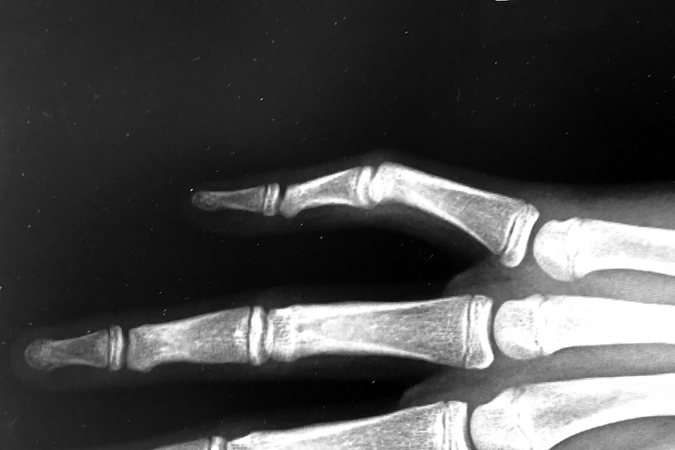 AP X-ray Camptodactyly right fifth finger.