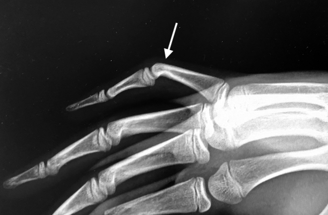 Lateral X-ray Camptodactyly right fifth finger.  Note small head of proximal phalanx and narrow sclerotic neck. (arrow).