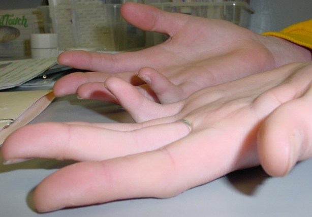 Bilateral Fifth Finger Camptodactyly