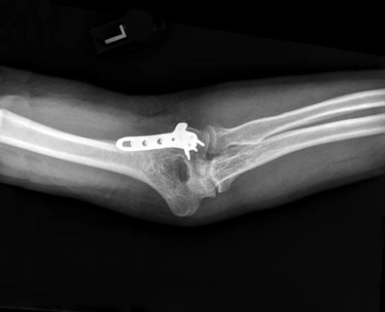 Healed capitellar fracture after ORIF which allowed early active range of motion.