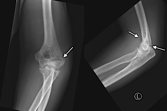 Left adult capitellar and later epicondylar fracture with arrows at fracture lines and at positive anterior fat pad sign.