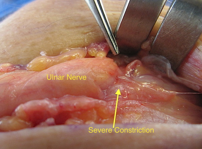 Carposcope Ulnar Neurolysis- Severely constricted ulnar nerve