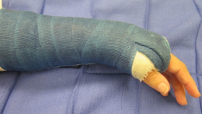 Short arm cast holding a non-displaced or reduced and stable distal radius fracture while it heals
