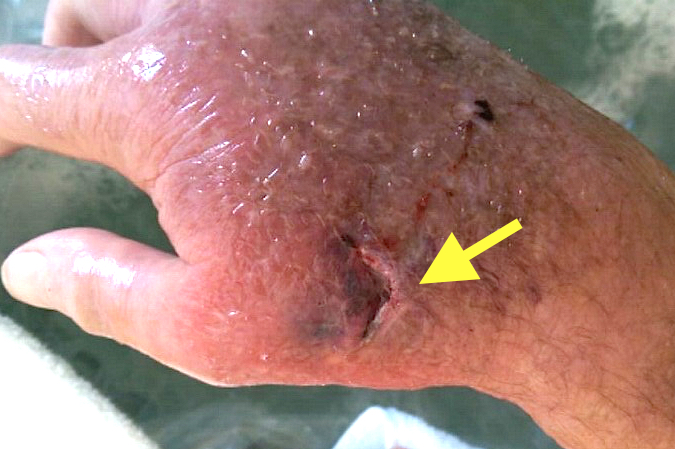 Cellulitis right hand starting to resolve after I & D of associated abscess