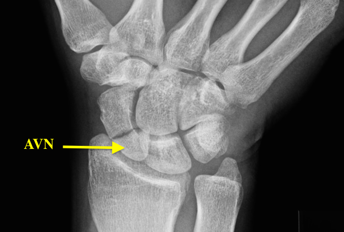 Chronic Scaphoid (Navicular) Fracture Prox 1/3;Mid 1/3 scaphoid ulnar deviated view with increase density in the proximal pole suggesting AVN.